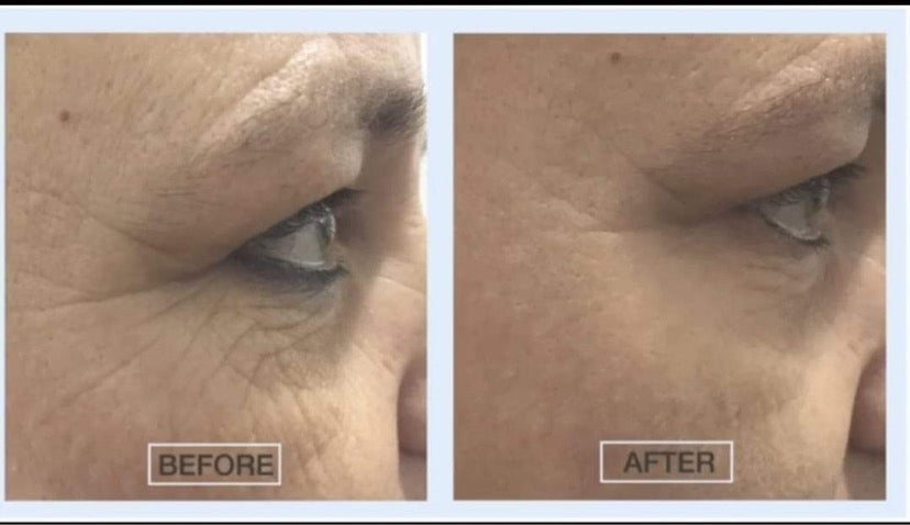 Before and after use of Fontainavie Complex Eye Serum showing reduced wrinkles and dark circles.